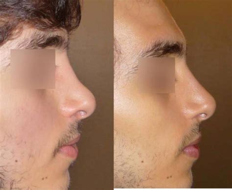 Nos activités Chirurgien expert en rhinoplastie à Paris Institut