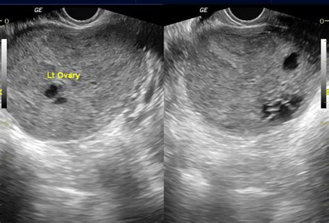 Ovarian Sertoli Leydig Cell Tumor Image