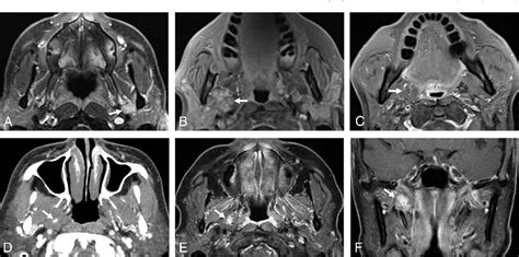 Figure 2 From Parapharyngeal Space Venous Malformation An Imaging