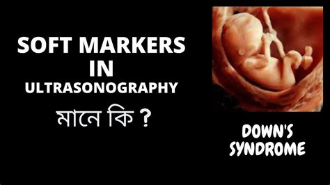 Soft Markers In Ultrasonography Youtube