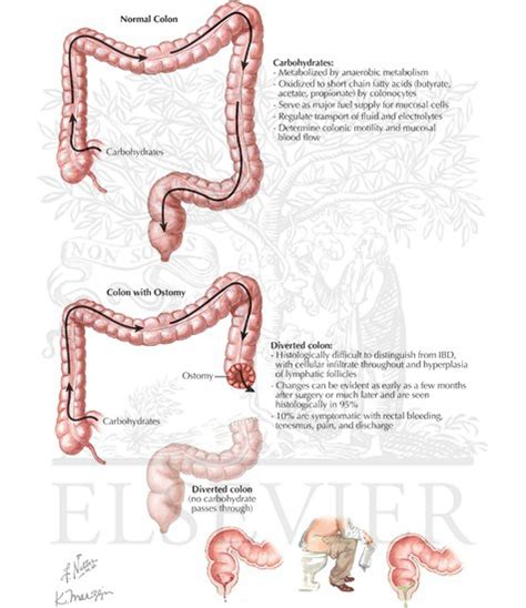 Diversion colitis