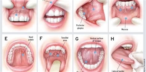 Les Signes Du Cancer De La Bouche Les Sympt Mes Et Sa Pr Vention