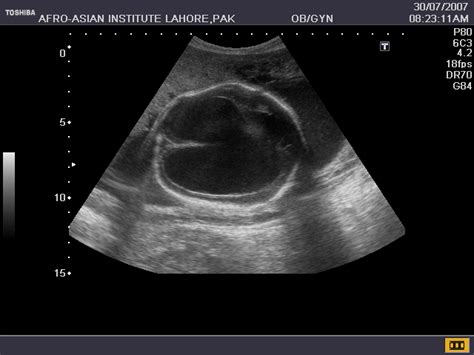 Hydranencephaly Ultrasound