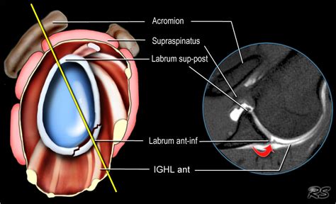 The Radiology Assistant Shoulder Anatomy And Variants On Mri