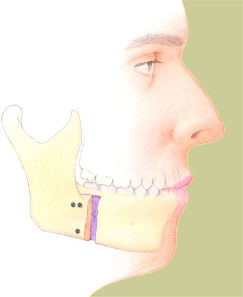 Mandibular Osteotomy Before And After