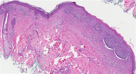 Mypathologyreport Ca