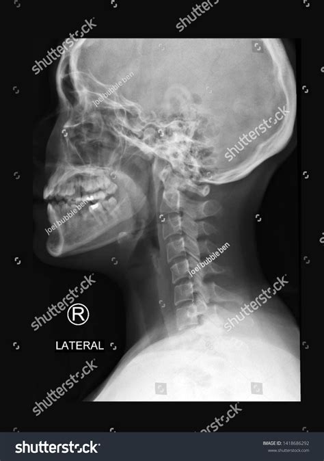 Fileskull Xray Lateral View Wikipedia