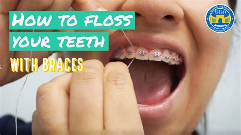 How To Floss With Braces Flossing Tips Youtube