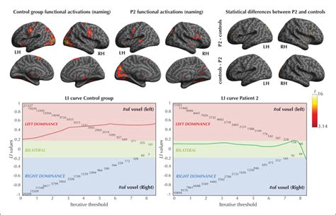 JLE Epileptic Disorders Multimodal Assessment Of Language And