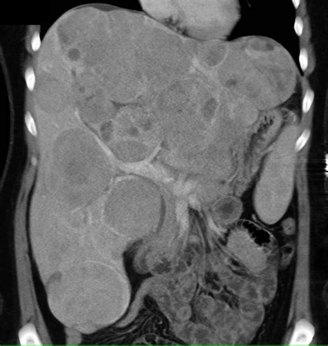 Metastatic Carcinoid Tumor To The Liver With Hypervascular Lesions