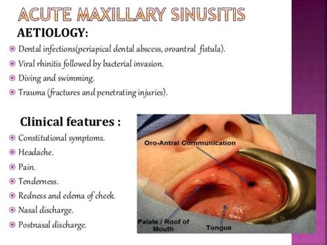 Acute And Chronic Sinusitis