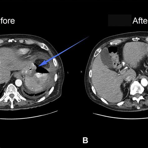 A Ct Scan Showing Retroperitoneal Mass And Air Suggestive Of A Download Scientific Diagram