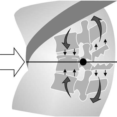 Diagram Illustrating The Forces Encountered During Flexion Distraction