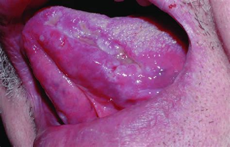 Syphilitic Chancre Of The Tongue Presenting As An Indurated