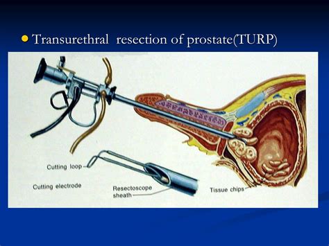 Ppt Benign Prostatic Hyperplasia Powerpoint Presentation Free