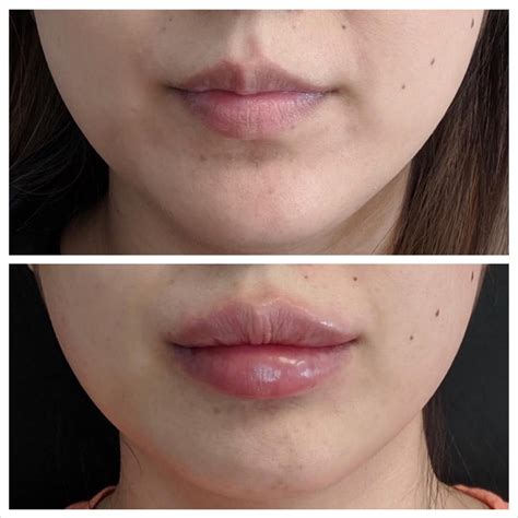 Saggy Lips From Lip Fillers Lipstutorial Org