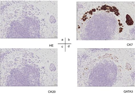 Immunohistochemical Staining Finding A Hematoxylin Eosin Stain