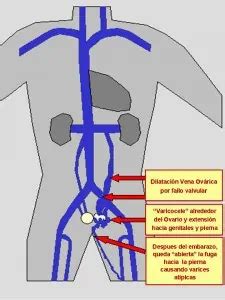 Sindrome De Congestion Pelvica Causa Poco Conocida De Dolor Abdominal