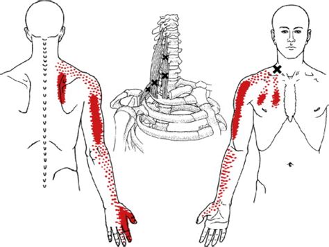 What Is Myofascial Pain Syndrome