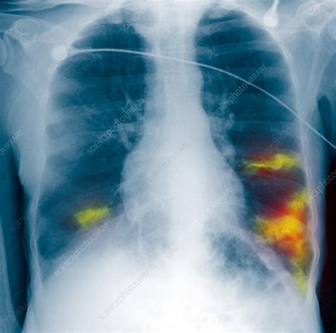 Pneumonia X Ray Stock Image M240 0477 Science Photo Library