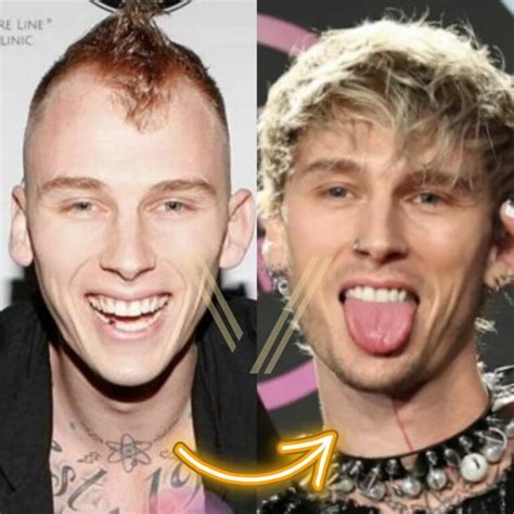 MGK S Hair Transplant Before And After Transformation