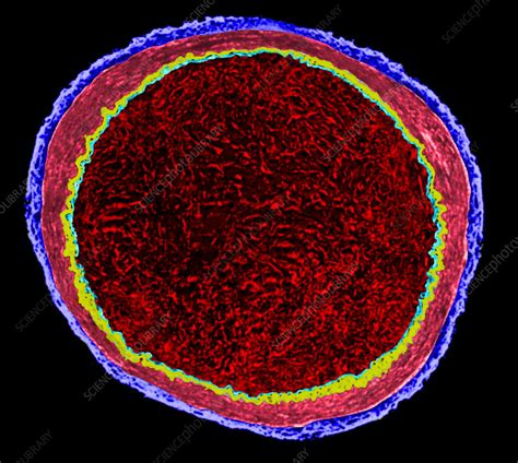 arterial embolus stock image  science photo library