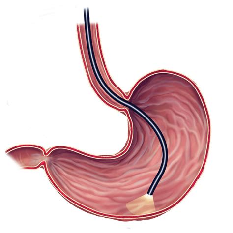 Upper Endoscopy Patient Information From Sages