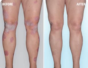 Psoriasis Before After Pictures Skyrizi Risankizumabrzaa