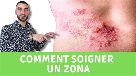 Comment soigner un zona remède et traitement naturel YouTube