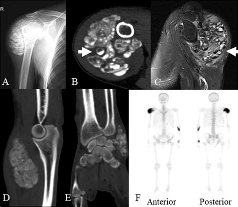 Figure From Multiple Uremic Tumoral Calcinosis In Periarticular Soft