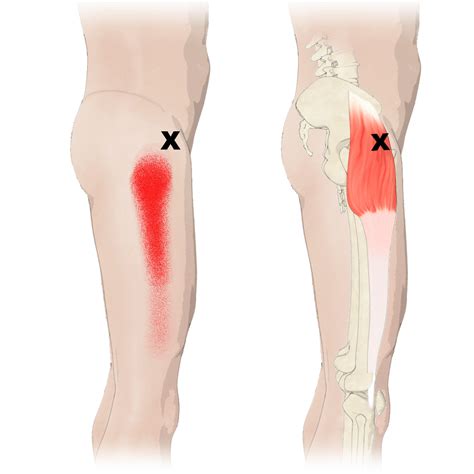 Tensor Fascia Latae And The Iliotibial Band