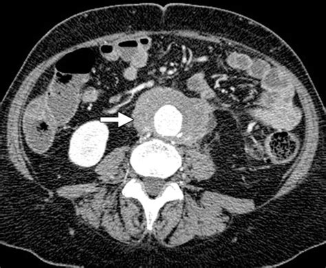 Imaging Of Uncommon Retroperitoneal Masses Radiographics