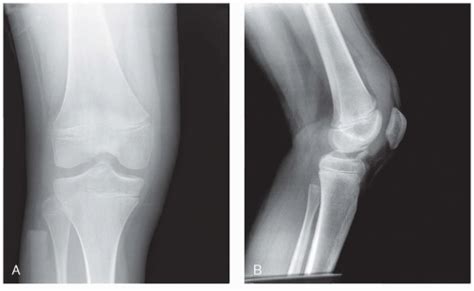 Tibial Spine Fracture Radiology