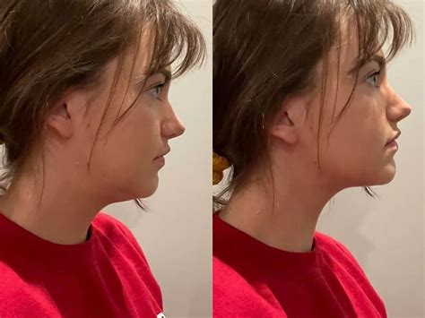 70 Mewing Before And After Double Chin Transformation After Mewing