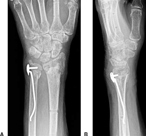 Figure 3 From Intrafocal Pin Plate Fixation Of Distal Ulna Fractures