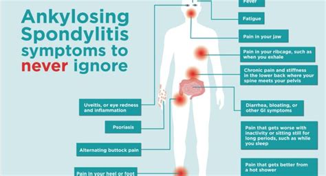 Ankylosing Spondylitis: Diagnosis and Treatment