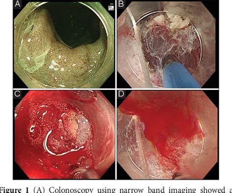 Figure From A Novel Gel Immersion Technique Using A Bipolar Needle