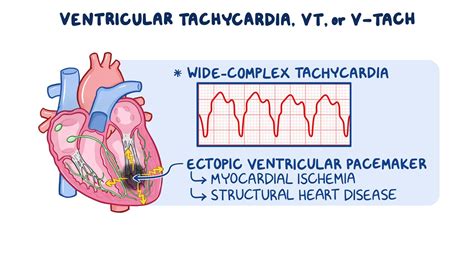Ventricular tachycardia: Clinical sciences - Osmosis Video Library