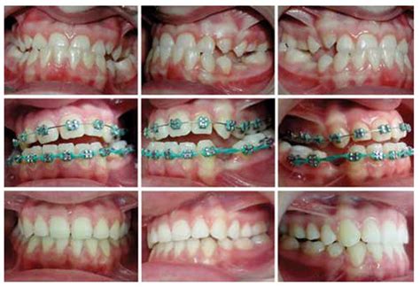 Using V Bends On Niti Wires For Nonsurgical Correction Of Class Iii