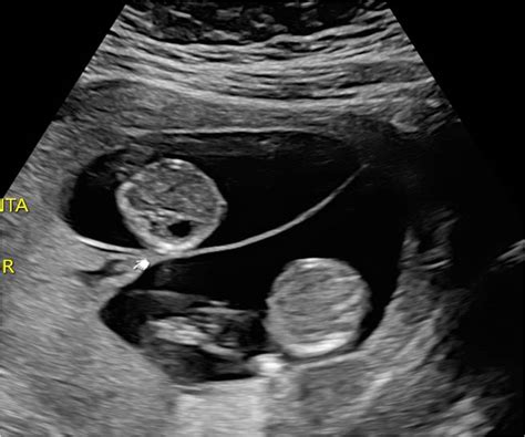 Multiple Pregnancy Lotus Fetal Scan Centre