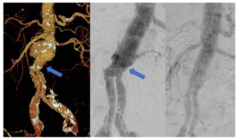 Jcm Free Full Text Mid Term Results Of Fenestrated Endovascular