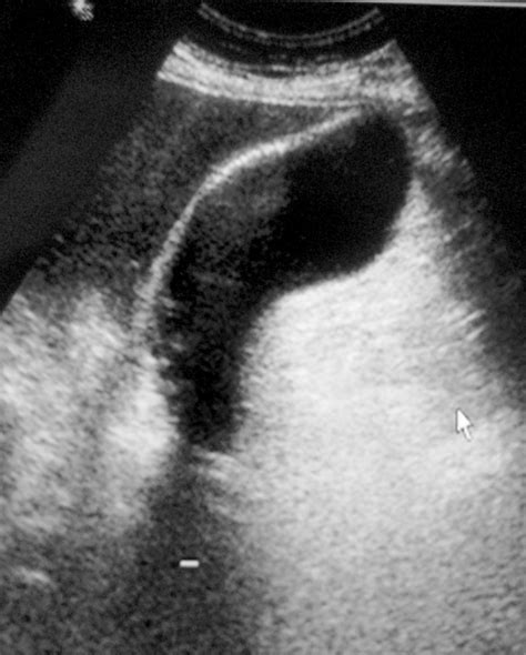 Emphysematous Cholecystitis Eurorad