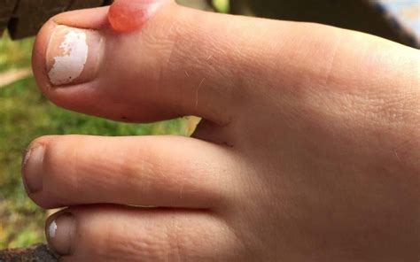 How To Prevent And Treat Blisters Uc Camping