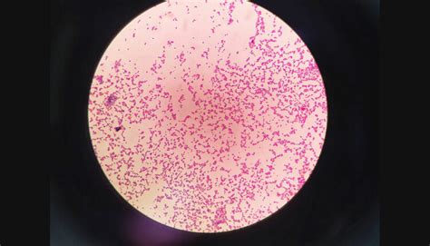 Fimbriae Periodontal Diseases Support System Decisions In Dentistry