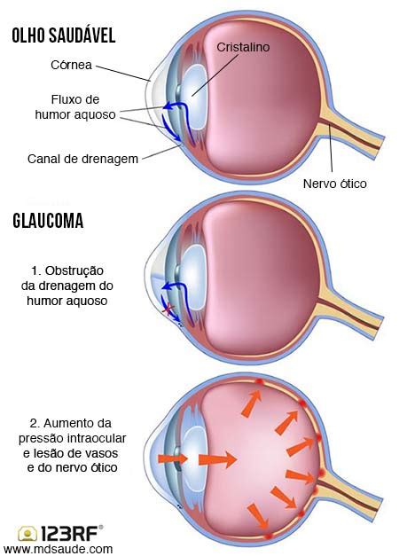 Glaucoma Sintomas tipos e risco de cegueira MD Saúde