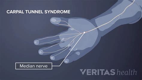 What Is Median Nerve Injury Symptoms Causes Diagnosis