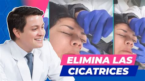 Eliminación De Cicatrices Con Láser Clínica Vásquez Lapel Youtube