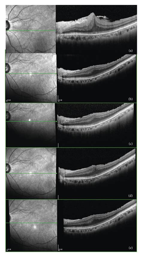 Pre And Postoperative Oct Findings In A Patient With More Long Term