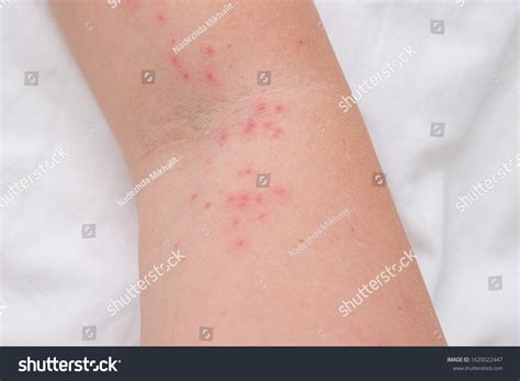 Skin Rash On Female Arm Itchy库存照片1620022447 Shutterstock