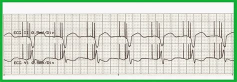 Practice Ekg Rhythm Strips 211